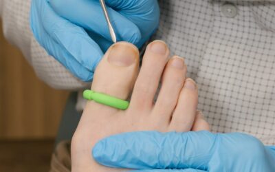 Can I Walk After Ingrown Toenail Surgery?